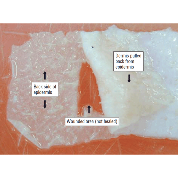 AMA: Topical Oxygen Emulsion - A Novel Wound Therapy