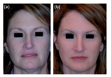 A 47-year-old woman (Group B, deep fractional followed by fully ablative CO 2 laser treatment) before (a) and (b) 3 months after laser treatments and the use of TOE for 30 days as post procedure aftercare. |