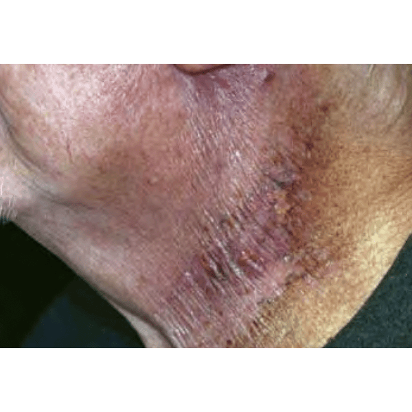 Cutagenix™ Radiation Dermatitis Case Report 1