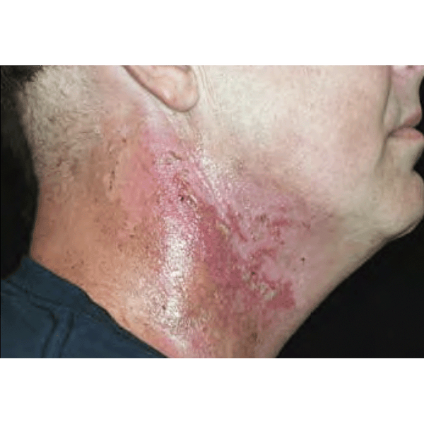 Cutagenix™ Radiation Dermatitis Case Report 2