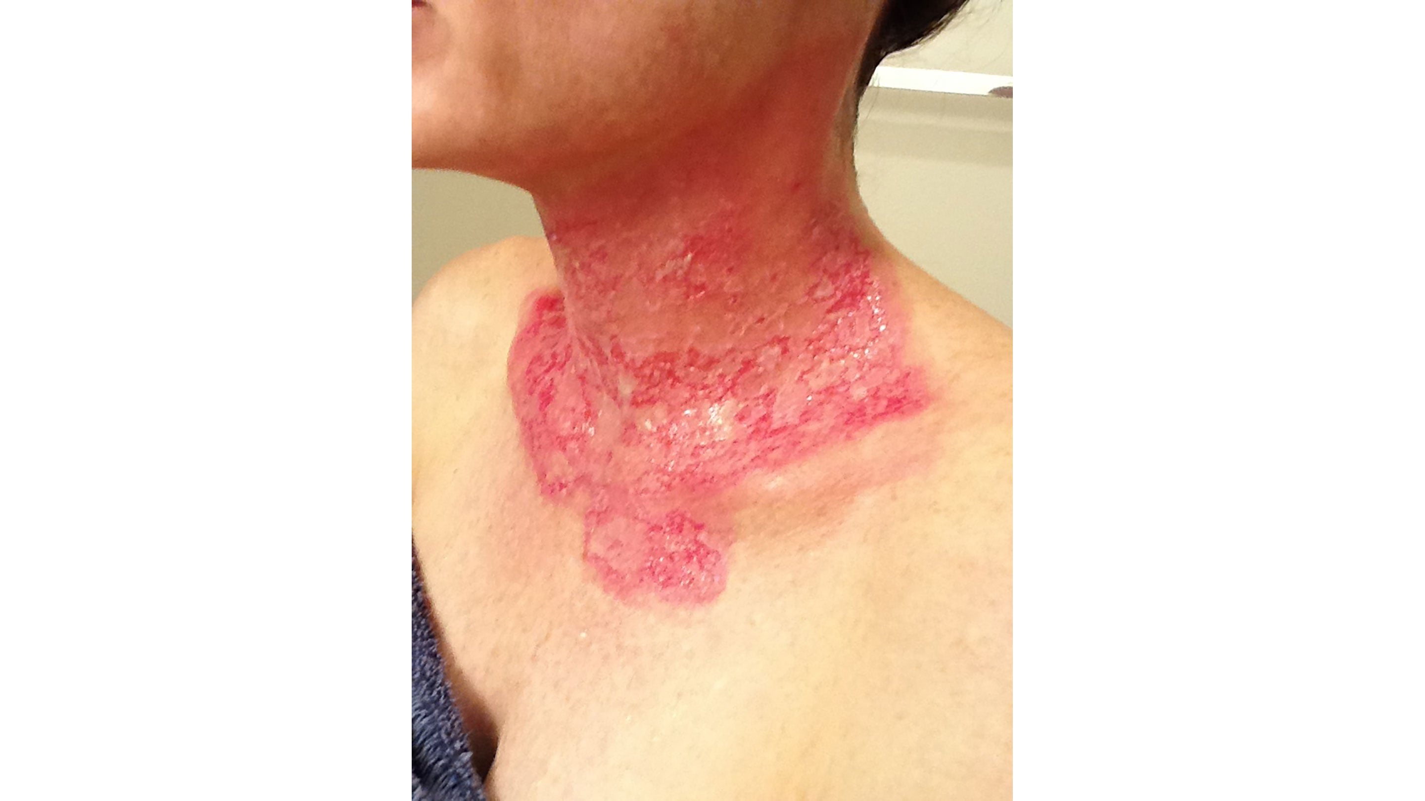 Before Photo - Cutagenesis™