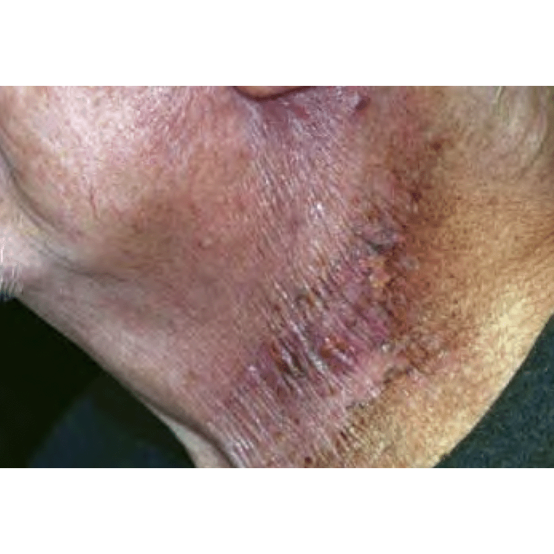 Radiation Dermatitis Case Report 1 – Cutagenesis