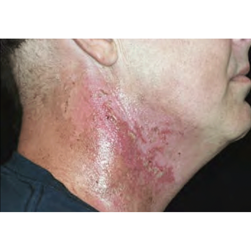 Radiation Dermatitis Case Report 2 – Cutagenesis