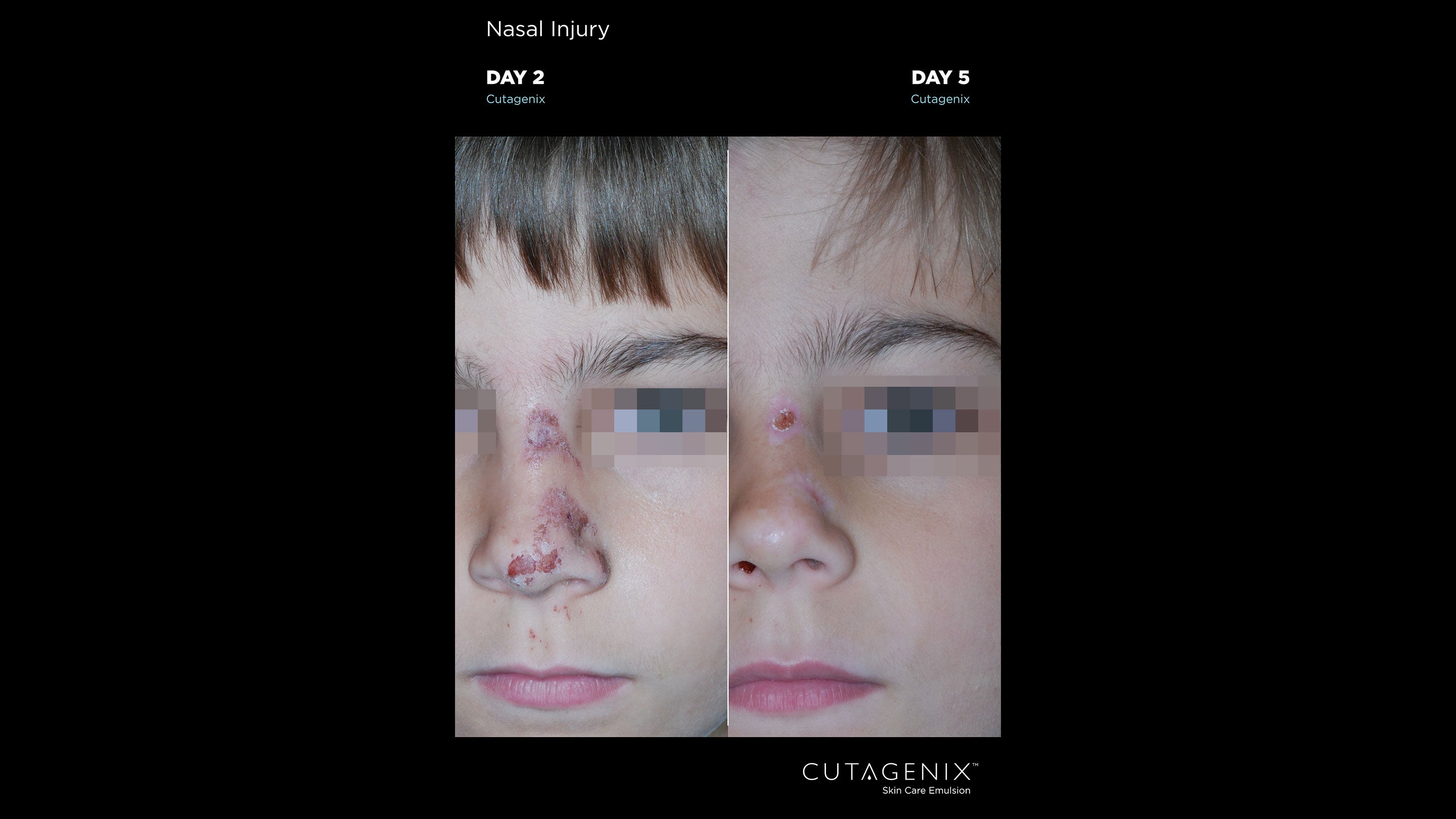 CUTAGENIX™ BEFORE AFTER BOY | Cutagenesis™ - Where Professional Skin Care Begins