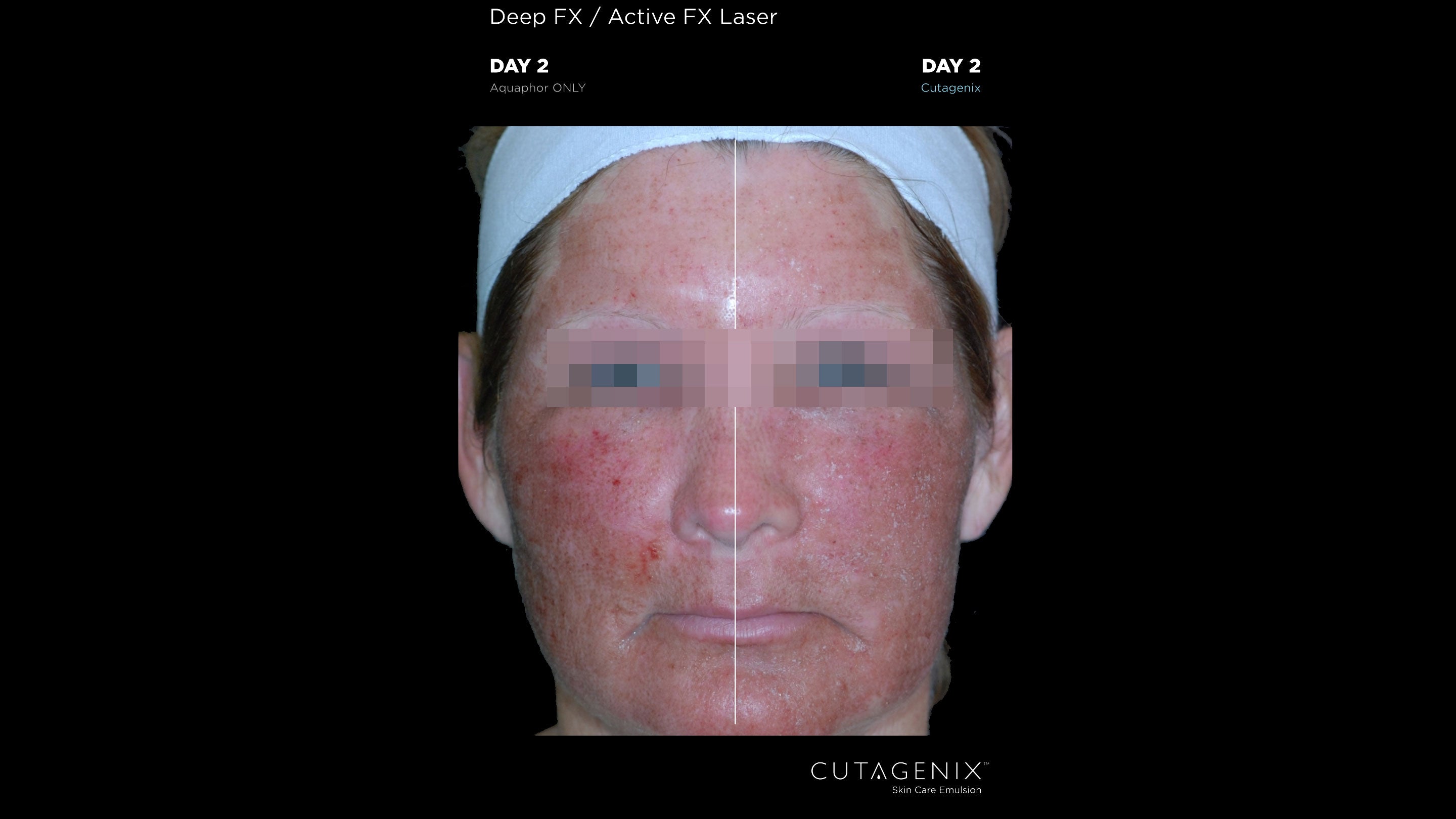 CUTAGENIX™ BEFORE AFTER WOMAN | Cutagenesis™ - Where Professional Skin Care Begins