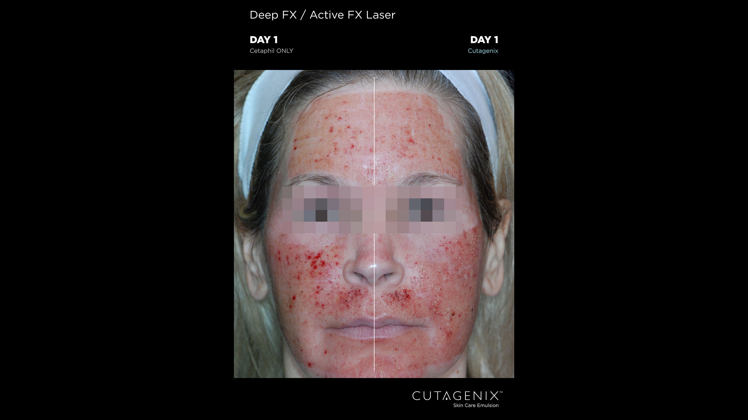 CUTAGENIX™vBEFORE AFTER WOMAN | Cutagenesis™ - Where Professional Skin Care Begins